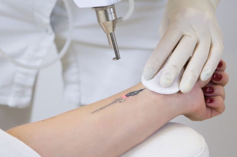 Remoção de Tatuagem à Laser